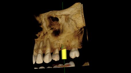 Escáner Dental 3D radiografía dental